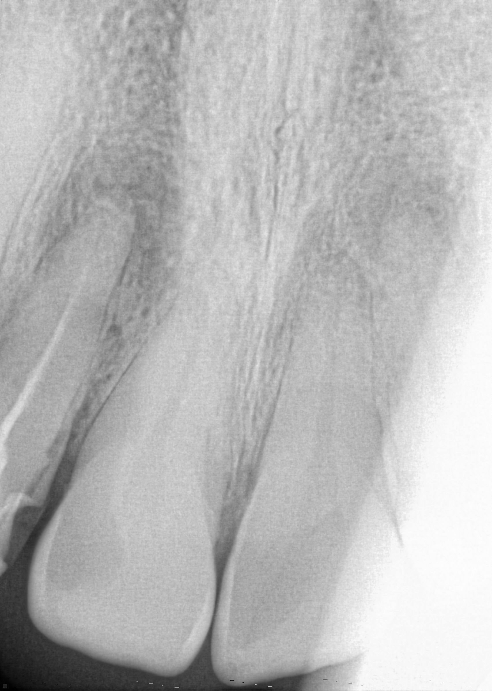 An X-ray showing defective root treatment of Gerry's upper right lateral incisor (Add/PA Real Life) Note to Editors: This image should only be used in conjunction with the PA Real Life story Real LIFE DentalErrors.  All usage is subject to a fee or included in your outlet's agreed content package.  For access or inquiries find a full copy of PA Quest or contact PA Real Life at RealLife2@pamediagroup.com or 020 7963 7175